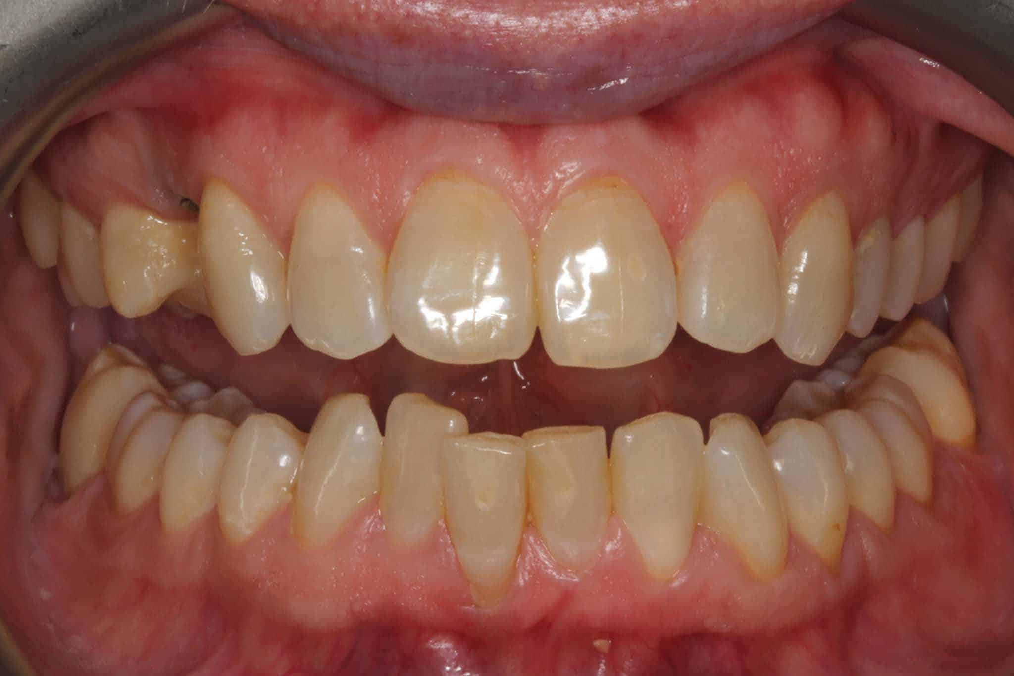 12-0-3-Kolbotn-Tannklinikk-Tannbleking-Blekeskinne-Før Før- og etterbilde: Hos Kolbotn Tannklinikk utføres profesjonell tannbleking med tydelig resultat – Kolbotn, Oppegård, Follo og Vinterbro.