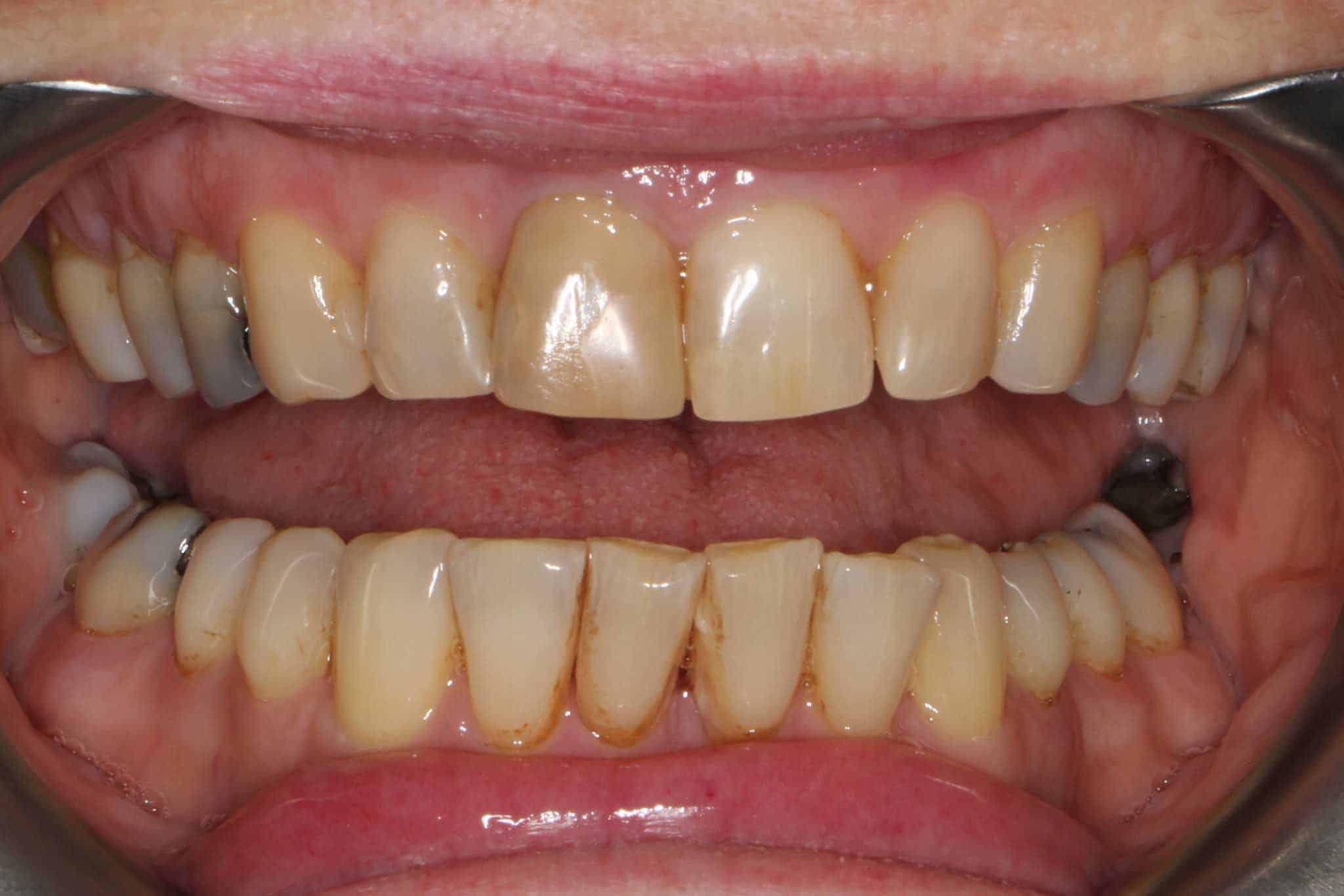 12-0-5-Kolbotn-Tannklinikk-Tannbleking-Blekeskinne-Før Før- og etterbilde: Tannlegene ved Kolbotn Tannklinikk viser resultat etter klinikk- eller hjemmebleking – Kolbotn, Follo, Myrvoll og Holmlia.