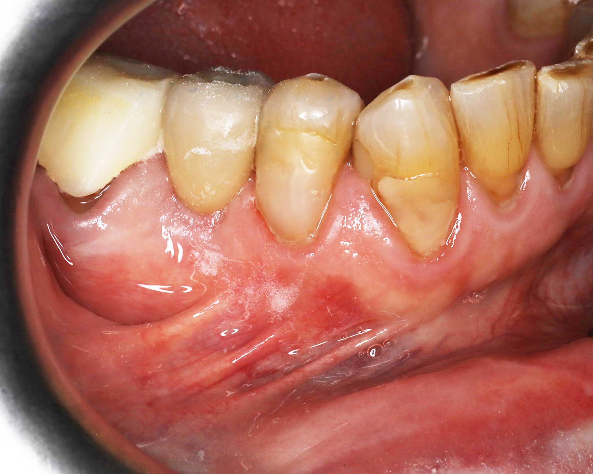 4-1-6-Kolbotn-Tannklinikk-Kunstig-Tann-Tannimplantat-Implantat Før- og etterbilde: Ved Kolbotn Tannklinikk viser tannlegene implantatresultat på røntgen og foto – pasienter i Kolbotn, Vinterbro, Nordstrand og Sofiemyr.