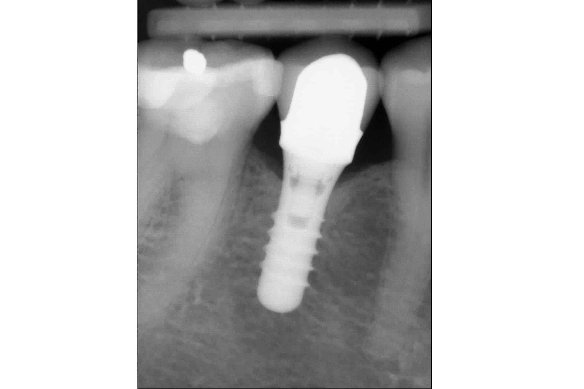 4-1-8-Kolbotn-Tannklinikk-Kunstig-Tann-Tannimplantat-Implantat Før- og etterbilde: Tannleger på Kolbotn Tannklinikk viser implantatbehandling – Kolbotn, Follo, Greverud og Hauketo.
