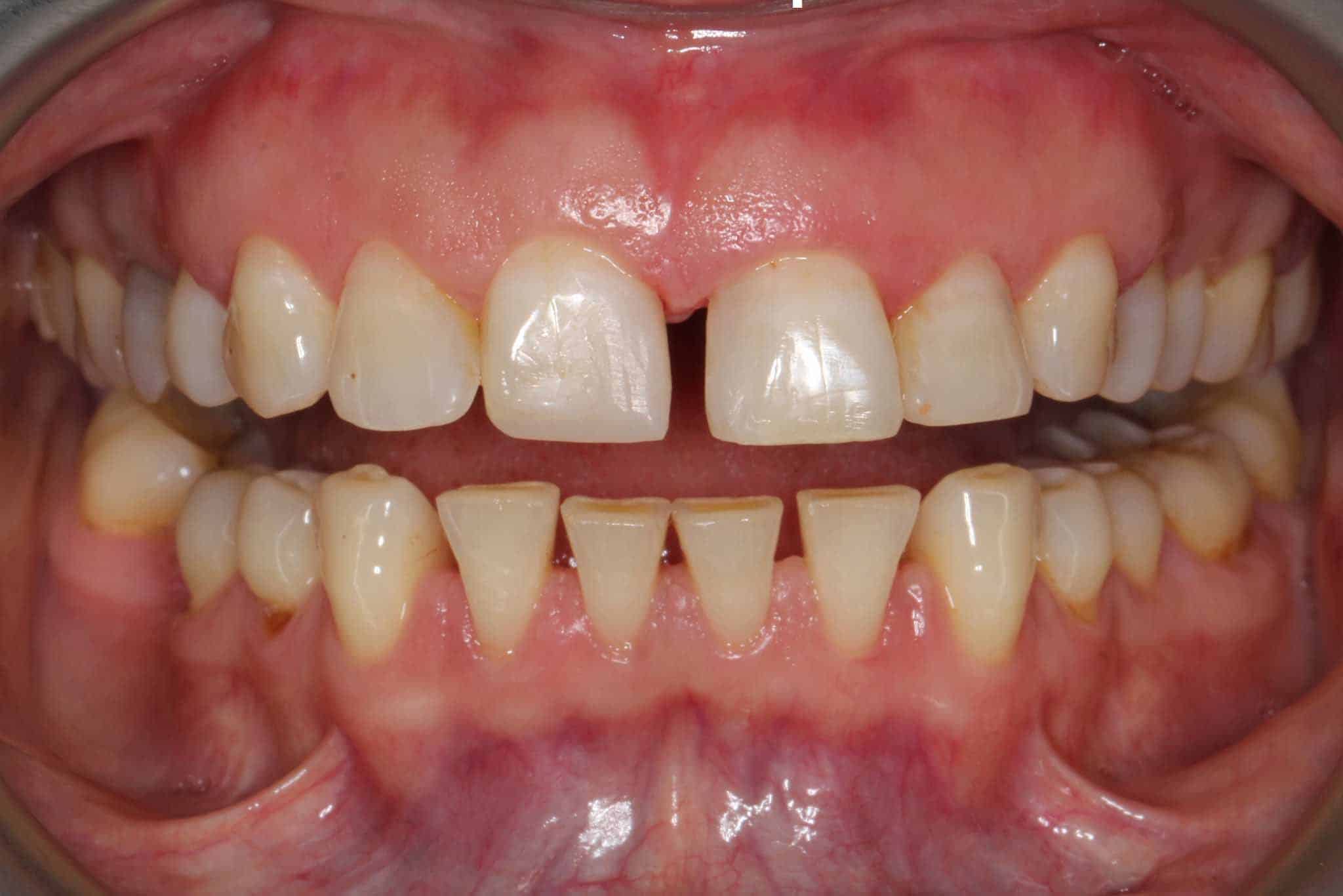 9-1-6-Kolbotn-Tannklinikk-Korttidstannregulering-Sammenlikning-Invisalign-Før Før- og etterbilde: Hos Kolbotn Tannklinikk rettes tennene med Invisalign og bygges opp med estetisk fyllingsmateriale – Kolbotn, Follo, Sofiemyr og Nordstrand.