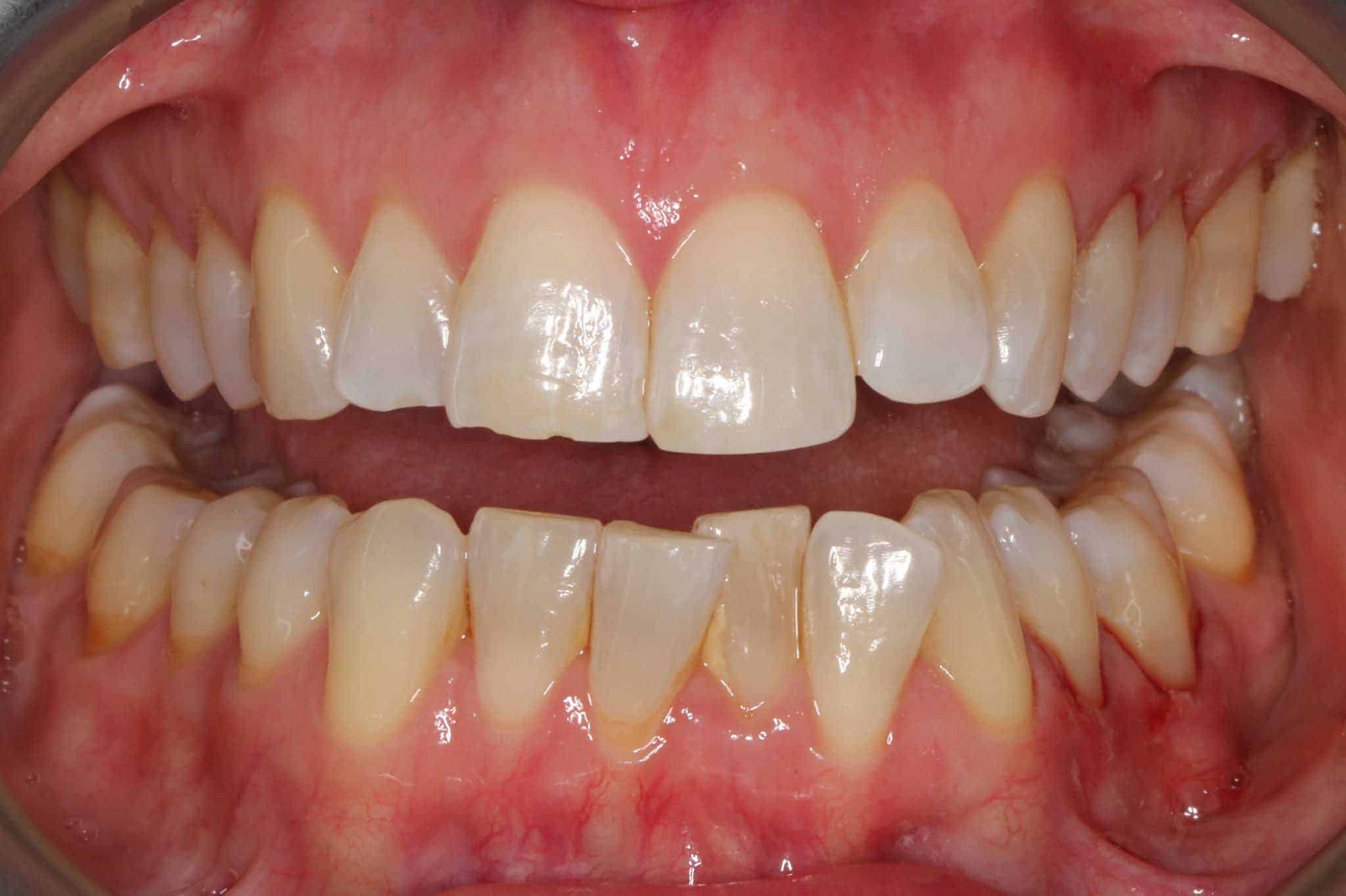 9-1-8-Kolbotn-Tannklinikk-Korttidstannregulering-Sammenlikning-Invisalign-Før Før- og etterbilde: Ved Kolbotn Tannklinikk kombineres Invisalign og fyllinger for å forbedre fortenner – Kolbotn, Vinterbro, Oppegård og Holmlia.