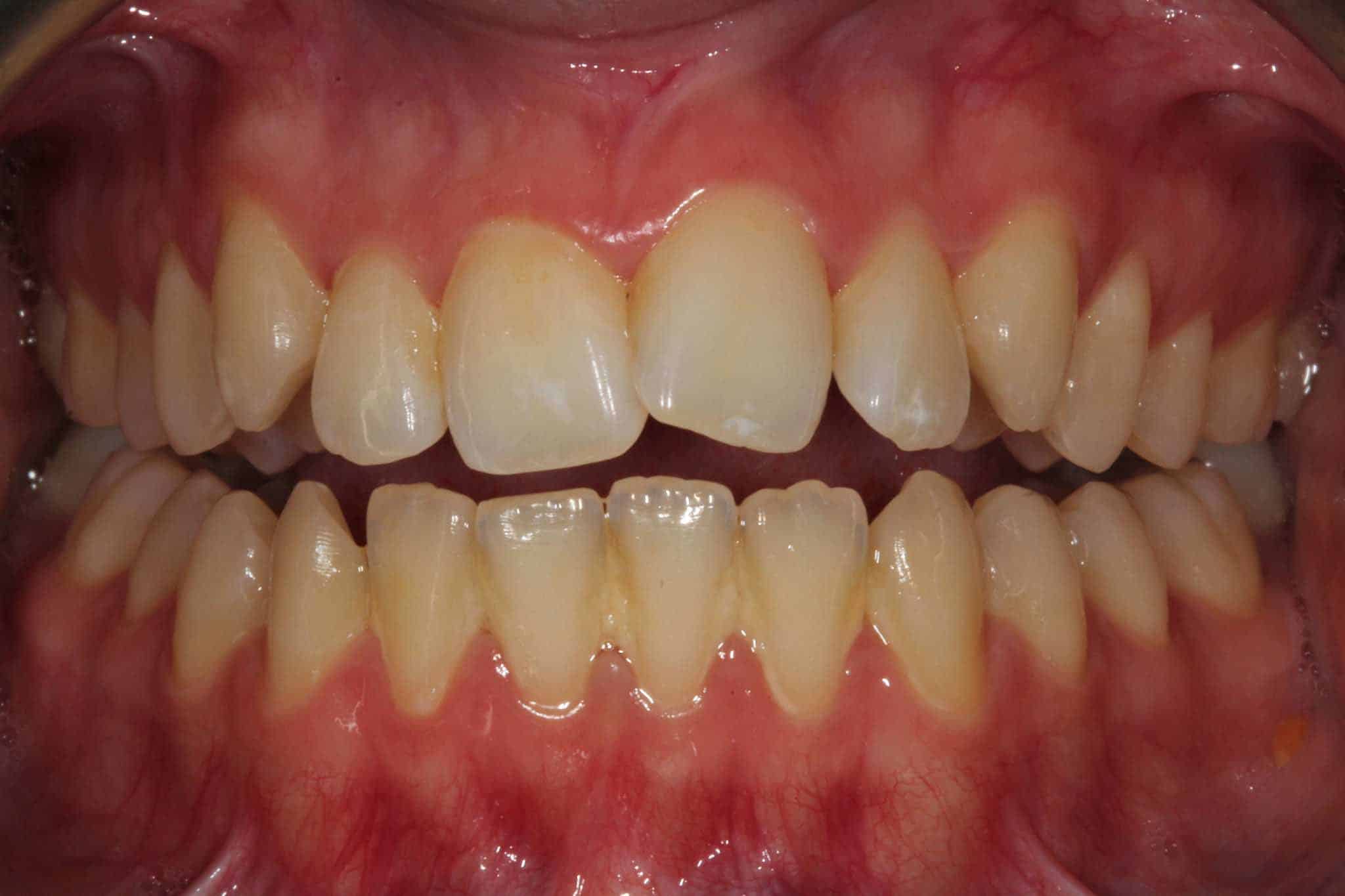 9-2-1-Kolbotn-Tannklinikk-Korttidstannregulering-Inman-Aligner-før Før- og etterbilde: Hos Kolbotn Tannklinikk rettes overkjevens fortenner med Inman Aligner – pasienter i Kolbotn, Follo, Oppegård og Nordstrand.