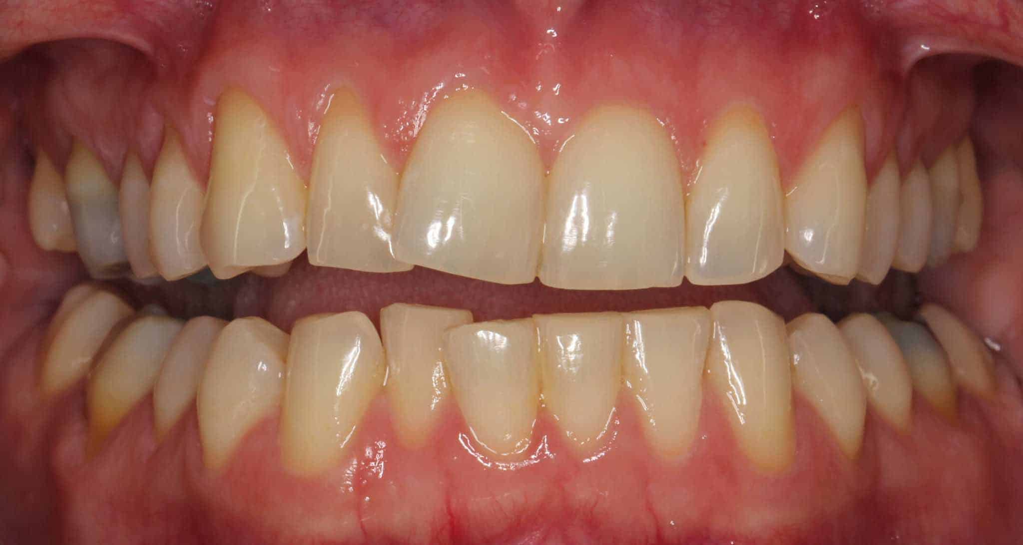 9-2-3-Kolbotn-Tannklinikk-Korttidstannregulering-Inman-Aligner-før Før- og etterbilde: Hos Kolbotn Tannklinikk rettes overkjevens fortenner med Inman Aligner – pasienter i Kolbotn, Follo, Oppegård og Nordstrand.