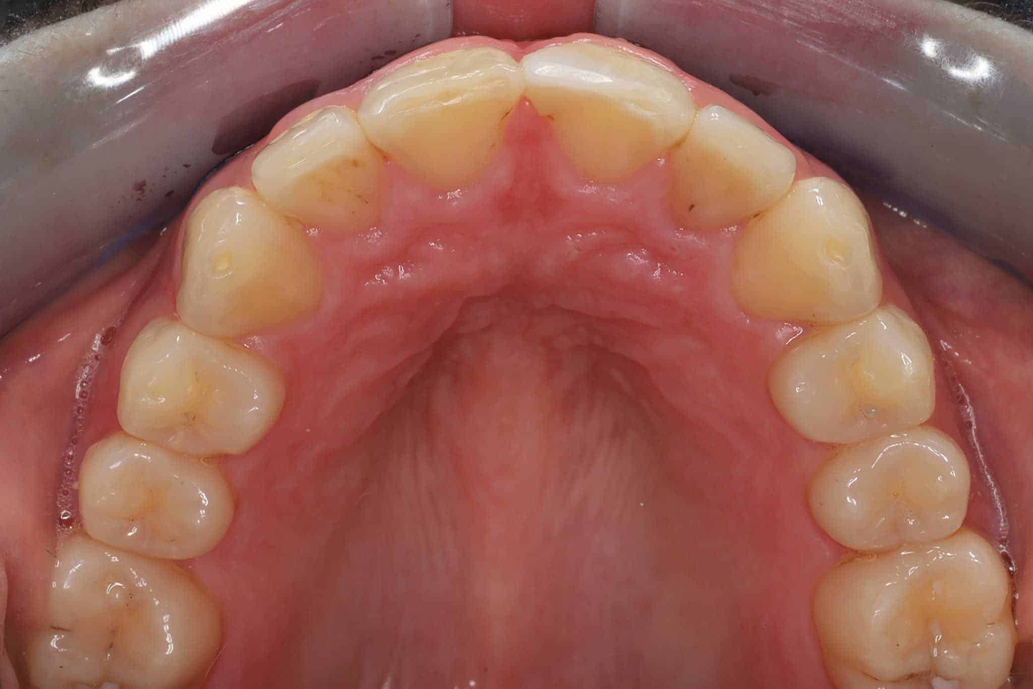 9-4-1-Kolbotn-Tannklinikk-Korttidstannregulering-Retainertråd-Før Før- og etterbilde: Tannlegene ved Kolbotn Tannklinikk monterer retainertråd på overkjeven – pasienter i Kolbotn, Follo, Vinterbro og Sofiemyr.