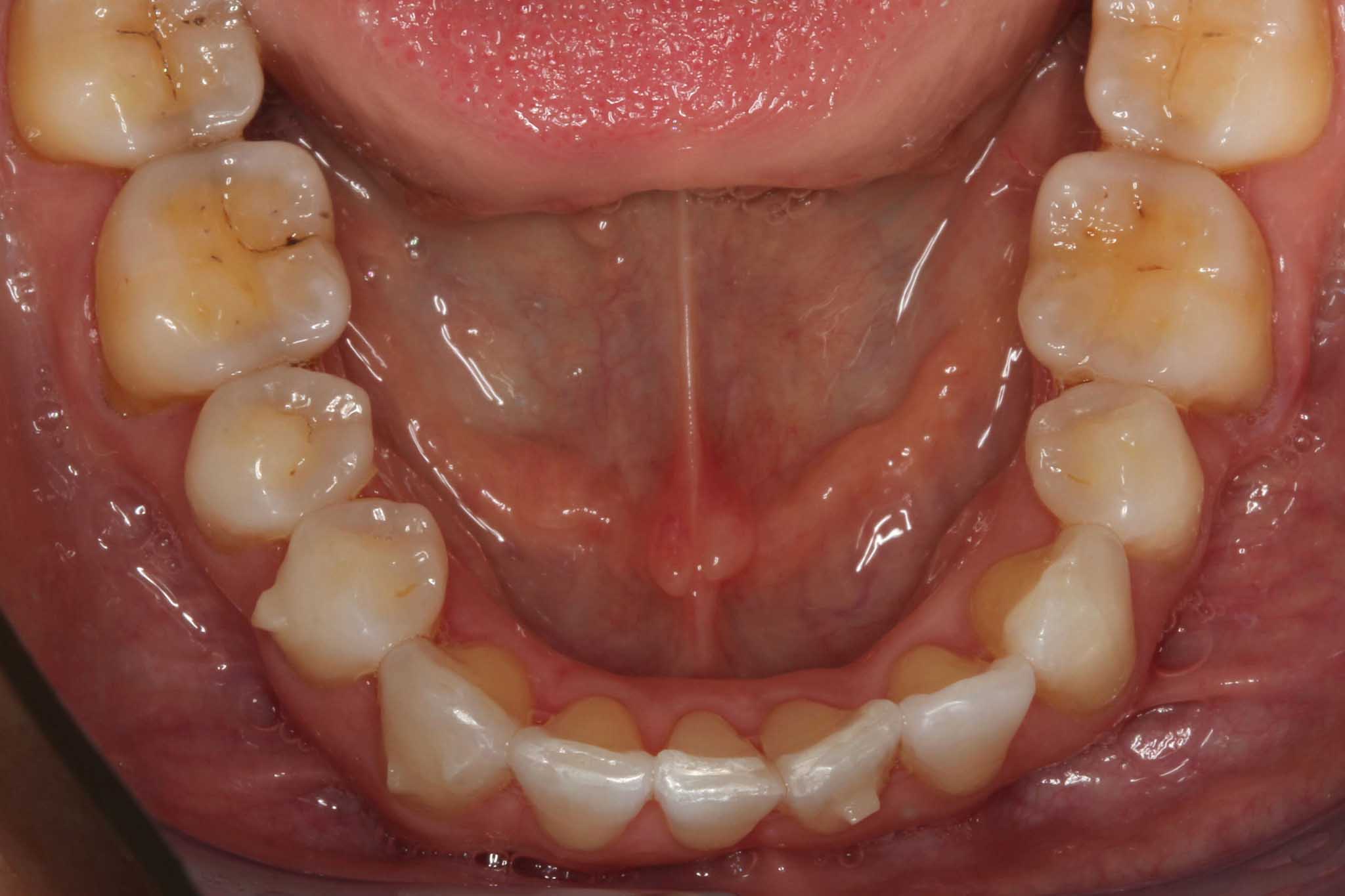 9-4-3-Kolbotn-Tannklinikk-Korttidstannregulering-Retainertråd-Før Før- og etterbilde: Tannleger på Kolbotn Tannklinikk monterer retainertråd på underkjevens fortenner – Kolbotn, Oppegård, Holmlia og Nordstrand.